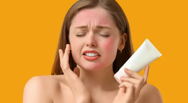 Donna con viso arrossato dal sole, che tiene in mano un tubetto di crema, cercando rimedi casalinghi per scottature da sole.
