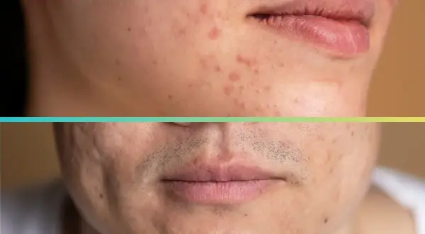 Primo piano di un viso con acne e cicatrici. Si cercano buchi sul viso rimedi naturali per migliorare l'aspetto della pelle.