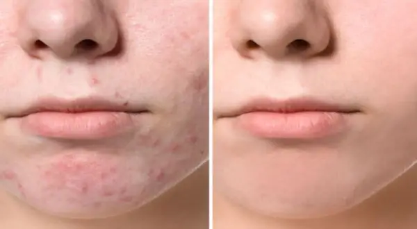 Confronto tra pelle con acne giovanile e pelle trattata, mostrando l'efficacia dei rimedi della nonna.