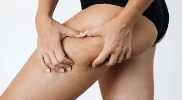 Mani che stringono la coscia, mostrando la texture della pelle con segni di cellulite edematosa. Alla ricerca di rimedi efficaci.
