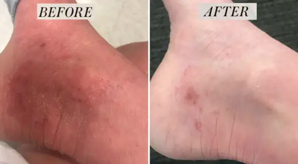 Piede prima e dopo: la pelle secca e screpolata migliora. Attenzione, le creme all'urea fanno male se usate impropriamente.