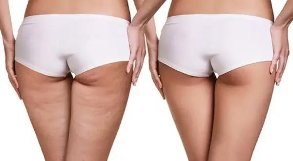 Confronto tra adipe e cellulite: la pelle a sinistra mostra la texture irregolare della cellulite, mentre a destra appare più liscia e tonica.