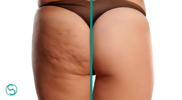 Confronto prima/dopo: la coscia sinistra mostra cellulite primo stadio, la destra pelle liscia e tonica.