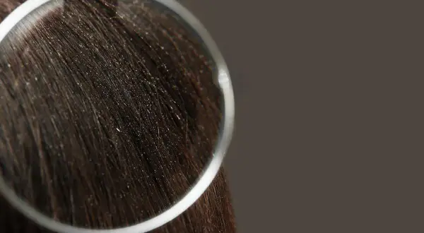 Capelli scuri con forfora visibile sotto lente d'ingrandimento. Scopri i migliori rimedi naturali per la forfora.