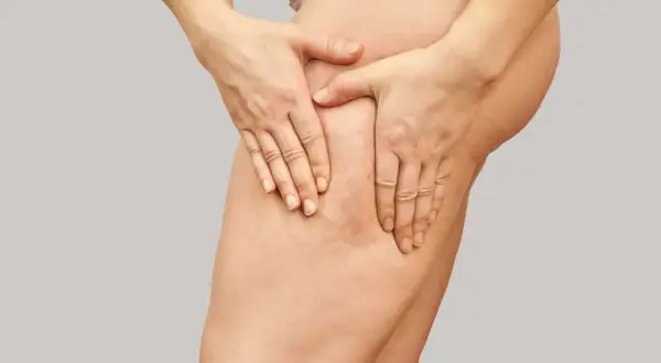 Mani che stringono la coscia, evidenziando la **cellulite acquosa** e la texture della pelle.