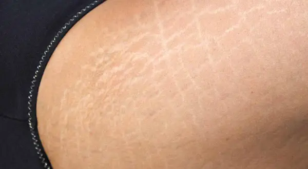 Dettaglio della pelle con smagliature sul bicipite, evidenziate da linee chiare e sottili.