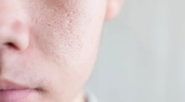 Primo piano della pelle di un uomo, mostrando cosa sono i pori dilatati e cicatrici da acne.