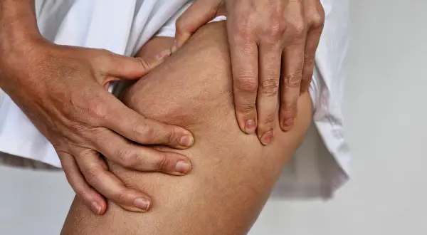 Mani che stringono la coscia, evidenziando la texture della pelle con cellulite e noduli sottopelle.