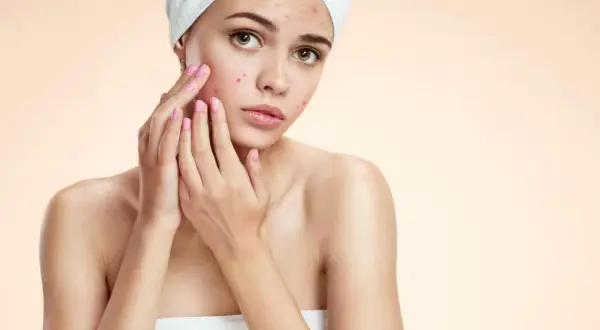 Ragazza con imperfezioni sul viso, preoccupata. Cerca una soluzione non comedogena per la sua pelle.