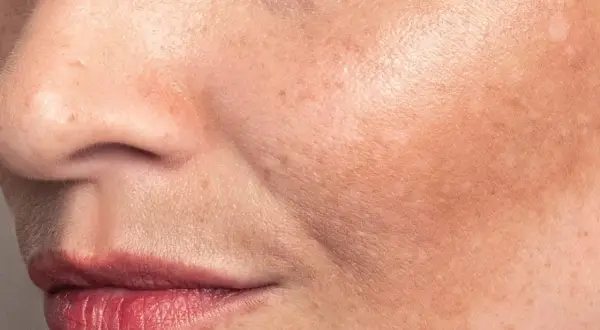 Primo piano del viso con macchie solari. La niacinamide può aiutare a ridurre le macchie solari e uniformare il tono della pelle.