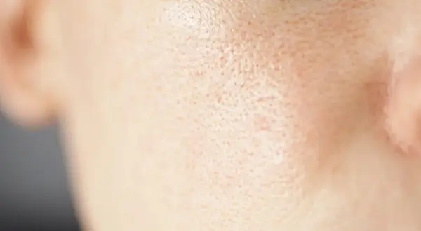 Primo piano della pelle del viso con pori dilatati sulle guance, evidenziando la texture.