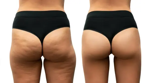 Confronto prima/dopo: la gamba sinistra mostra cellulite dolorosa e irregolarità, la destra appare liscia e tonica.