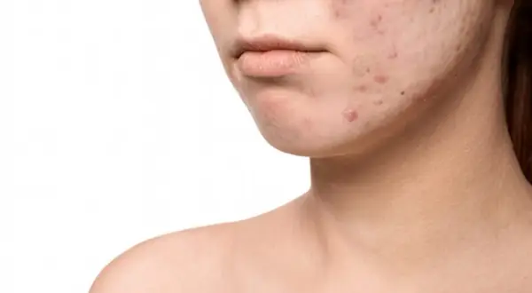 Primo piano di un volto con pelle congestionata e acne. Imperfezioni visibili sul mento e sulla guancia.