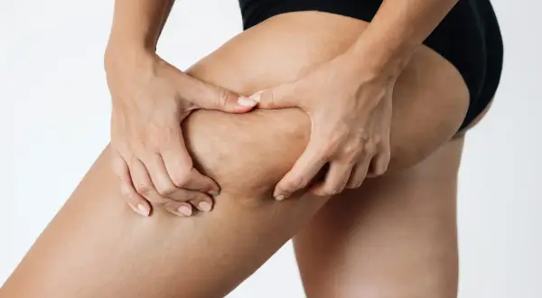 Mani che pizzicano la coscia, mostrando i diversi stadi della cellulite sulla pelle.