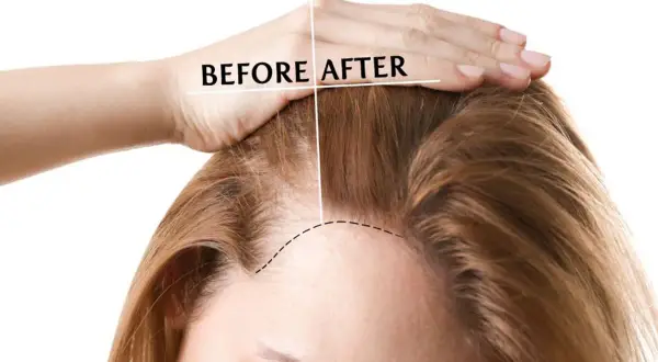 Prima e dopo: capelli più folti grazie ai rimedi della nonna per rinforzare i capelli.