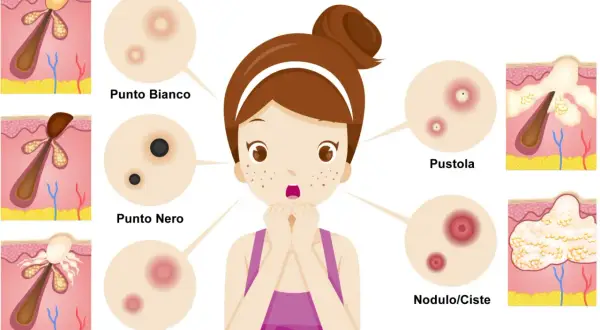 Ragazza preoccupata per i brufoli: punto bianco, punto nero, papula, pustola e nodulo/cisti illustrati.