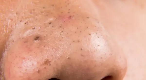 Primo piano del naso con pori dilatati e punti neri. Si vede cosa esce dai punti neri, accumuli di sebo e cellule morte.