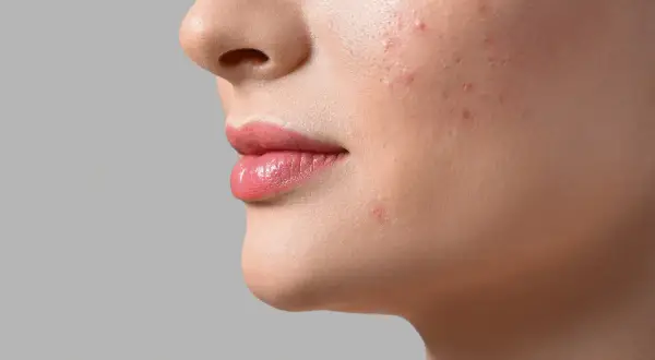 Primo piano del viso di una donna con imperfezioni. La pelle beneficia di niacinamide e acido glicolico per un aspetto più uniforme.