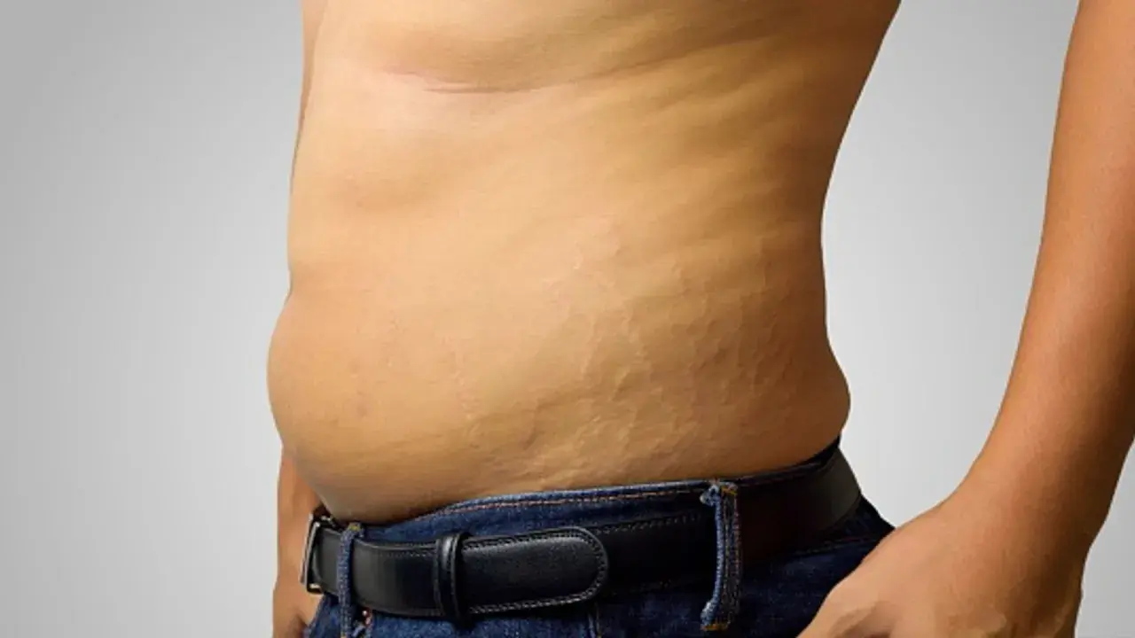 Primo piano della pancia di un uomo con smagliature visibili, evidenziando la texture della pelle.