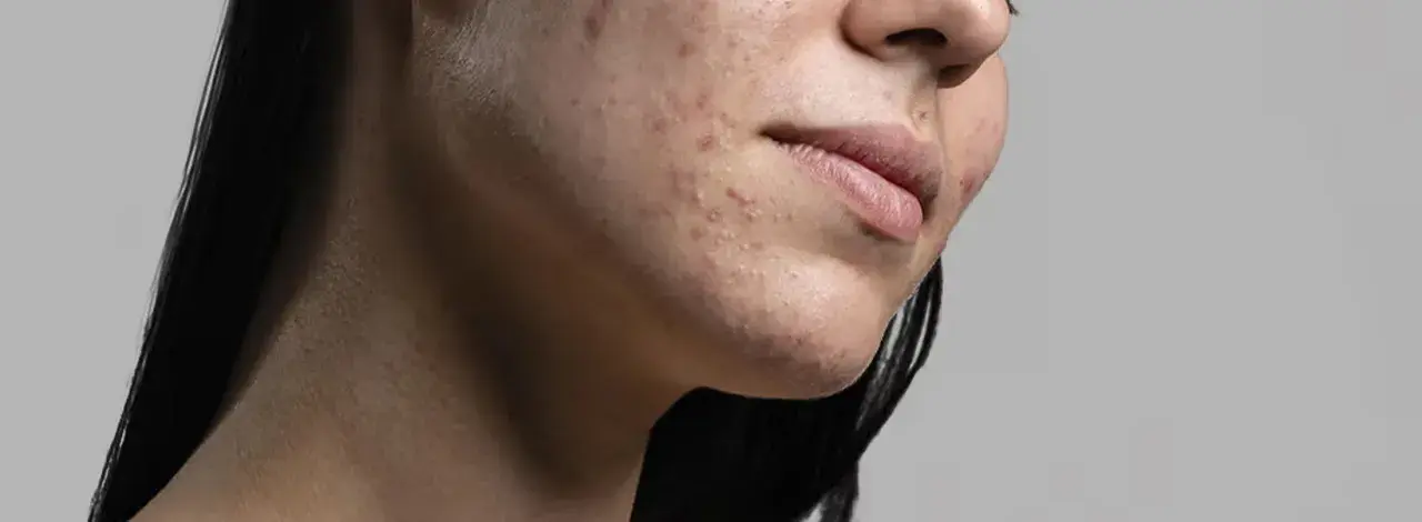 Primo piano del viso di una donna con acne. La resorcina cos'è? Un trattamento per la pelle.