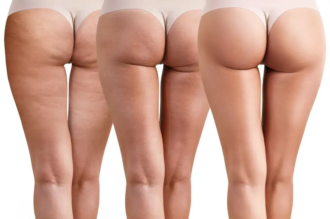 Gambe con cellulite fibrotica visibile, che mostra la progressione verso una pelle più liscia.