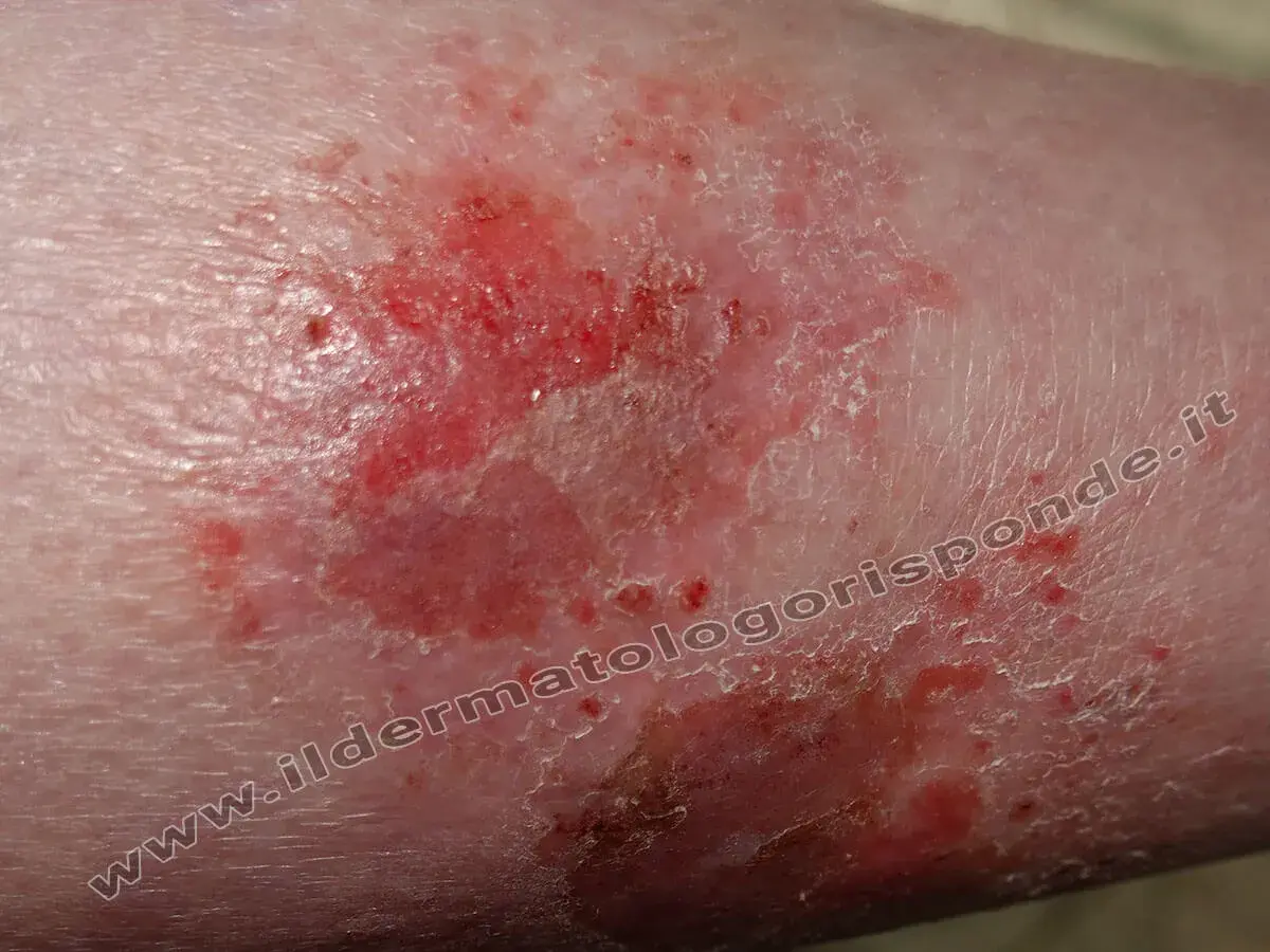Macchie infiammate e screpolate sulle gambe, con aree arrossate e desquamazione.