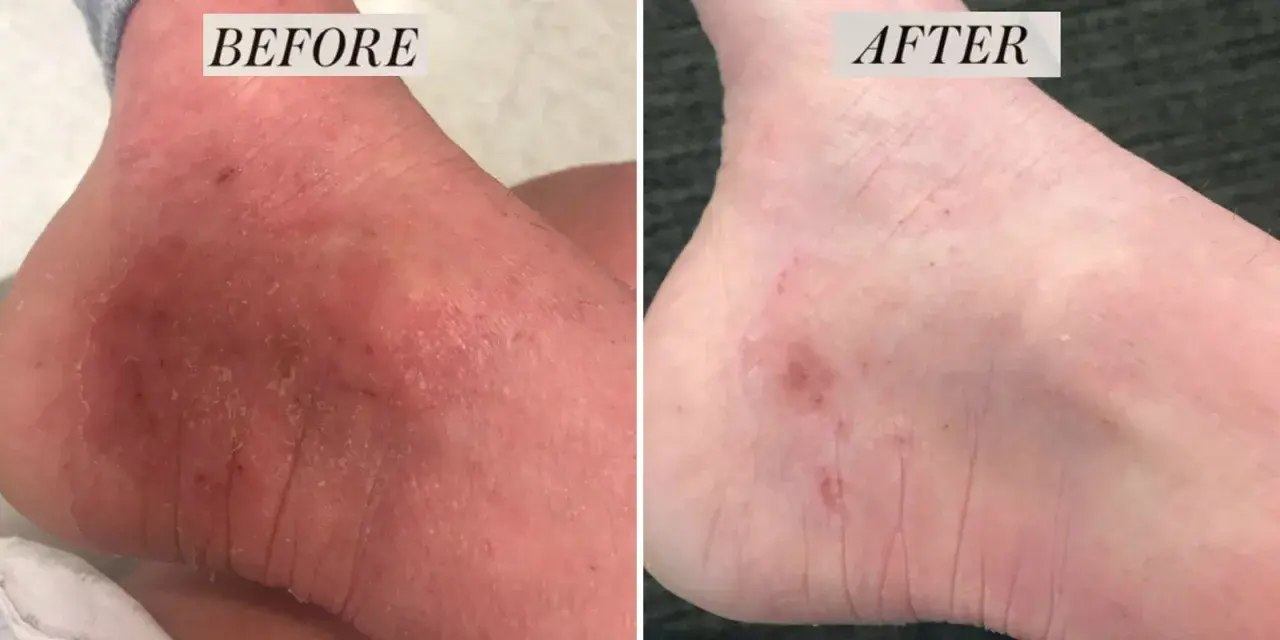Piede prima e dopo: la pelle secca e screpolata migliora. Attenzione, le creme all'urea fanno male se usate impropriamente.