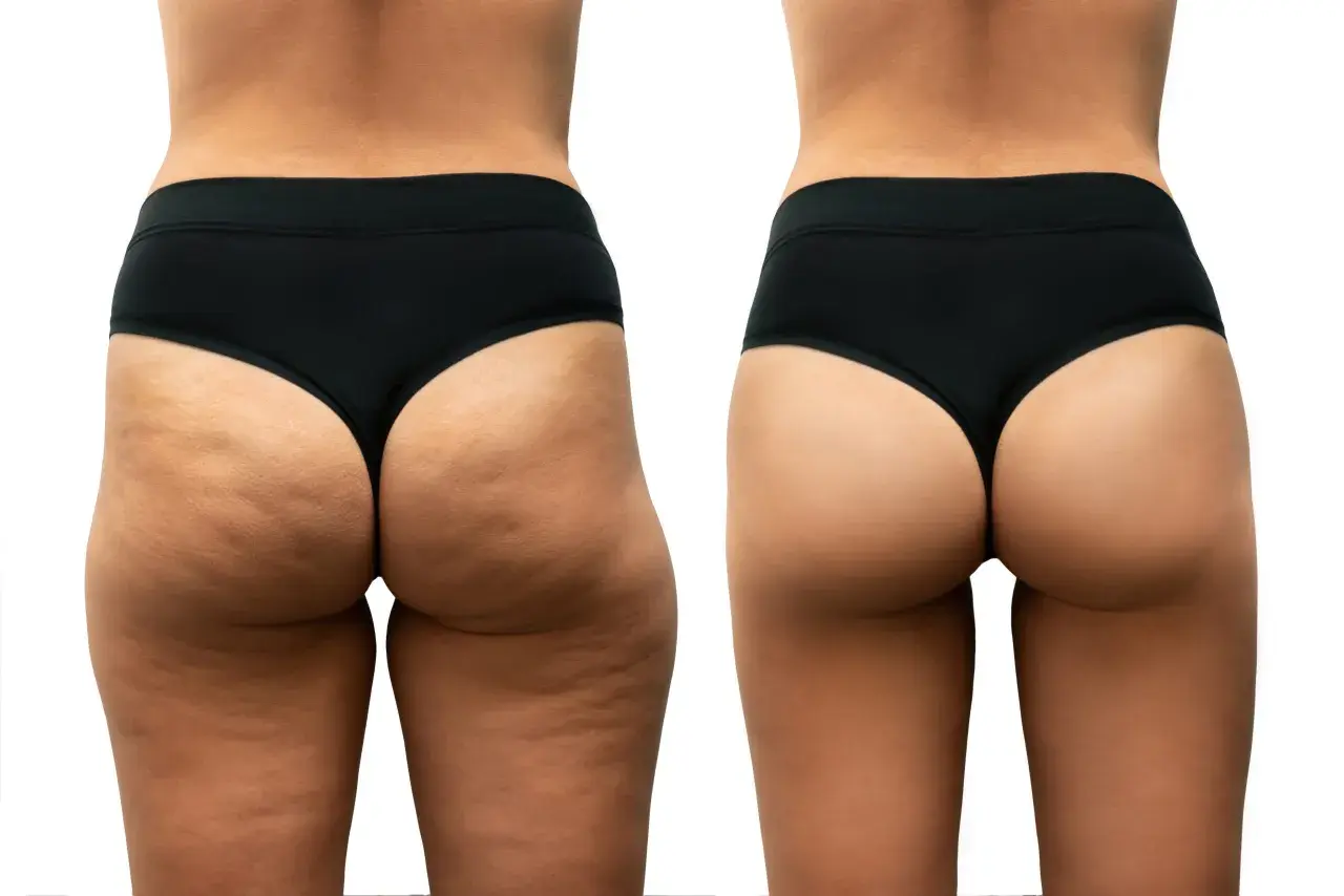 Confronto prima/dopo: la gamba sinistra mostra cellulite dolorosa e irregolarità, la destra appare liscia e tonica.