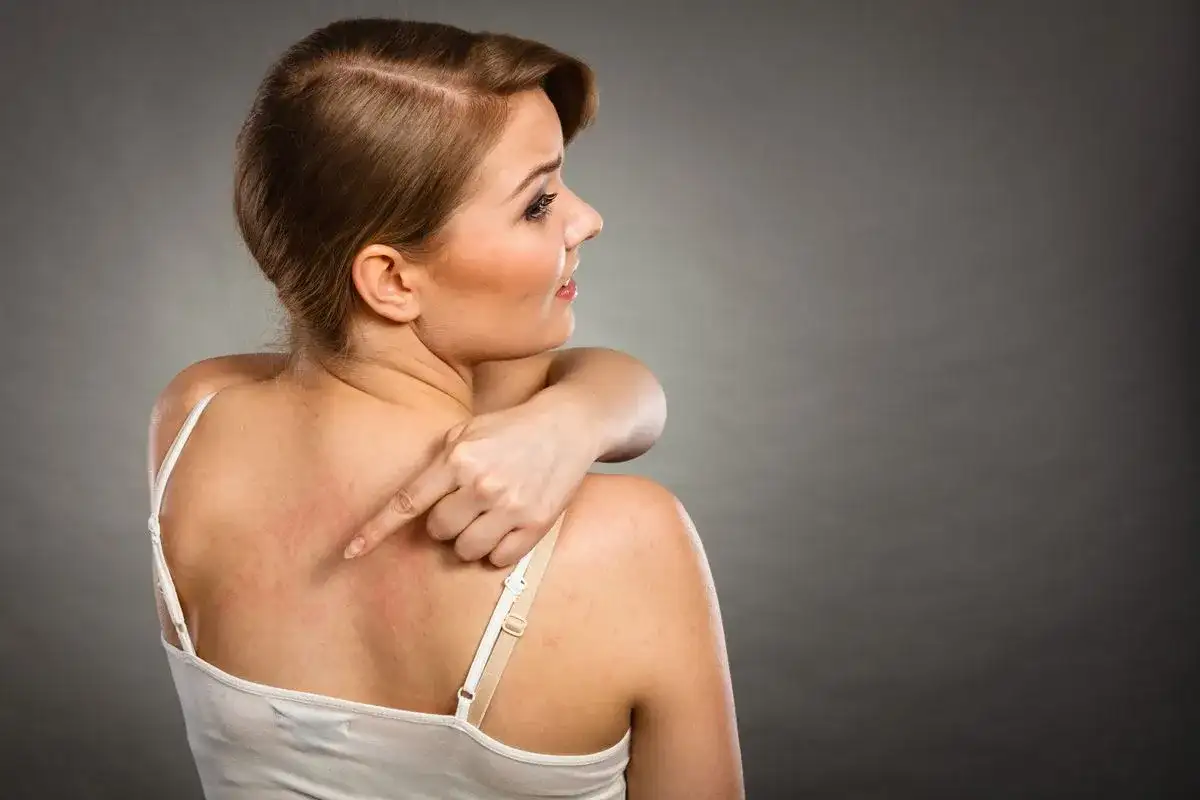 Donna si tocca la schiena arrossata, indicando un fastidioso punto nero che non esce.
