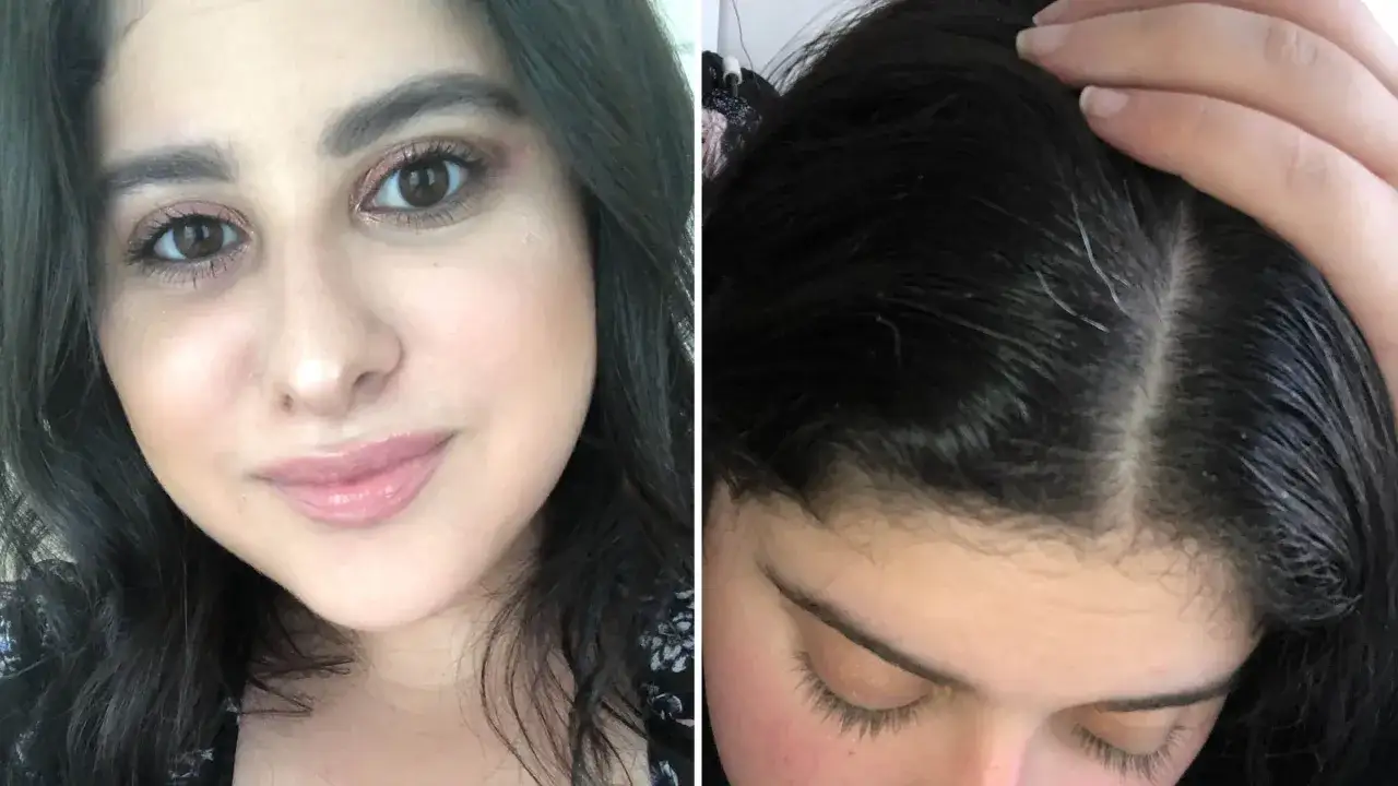 Primo capelli bianchi che spuntano tra i capelli scuri.