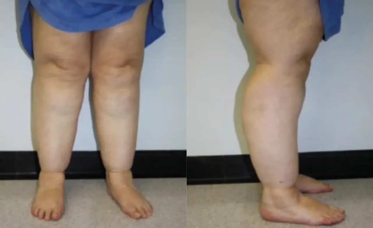Gambe gonfie e polpacci grossi donne cause: edema, linfedema, problemi circolatori.