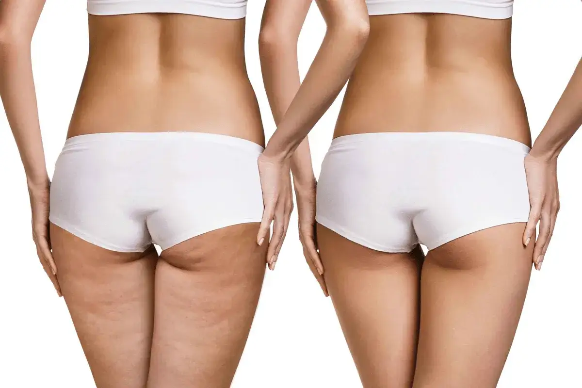 Confronto tra cosce: a sinistra, la cellulite fa male e si vede; a destra, pelle liscia e tonica.