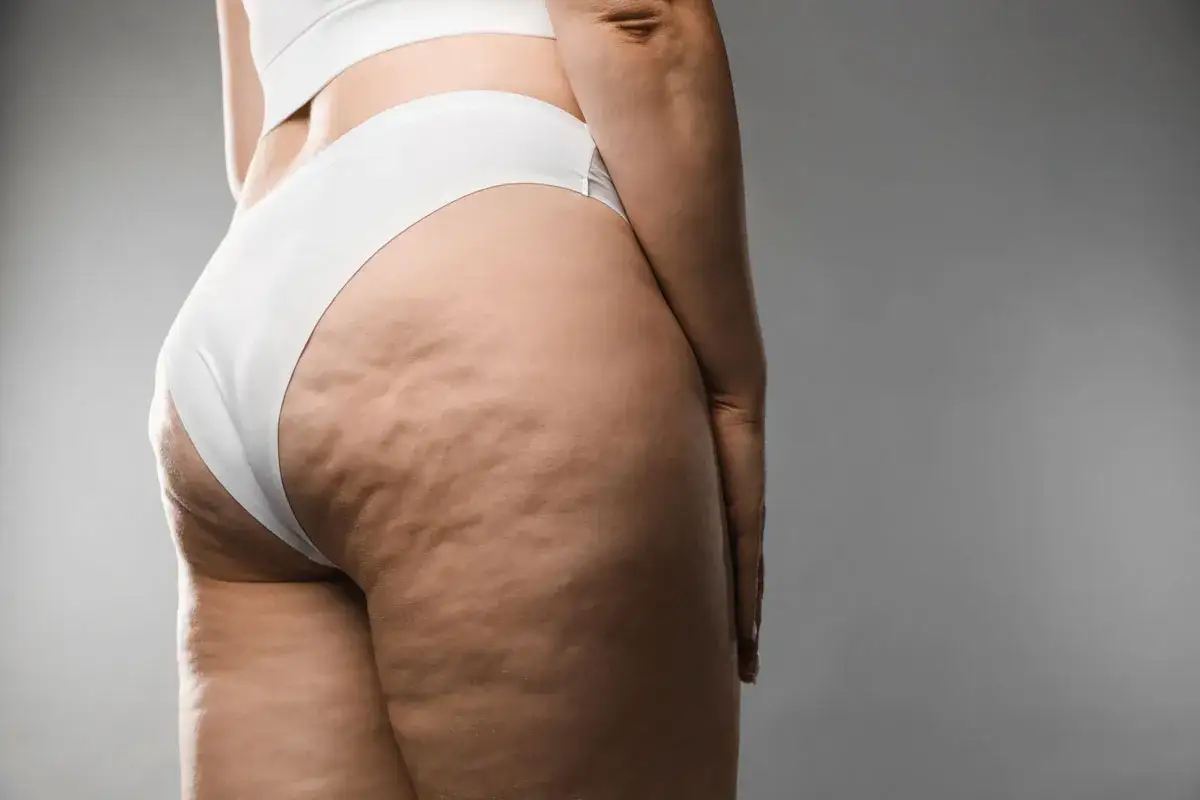 Gambe e glutei con evidente cellulite sclerotica, mostrando la texture della pelle.