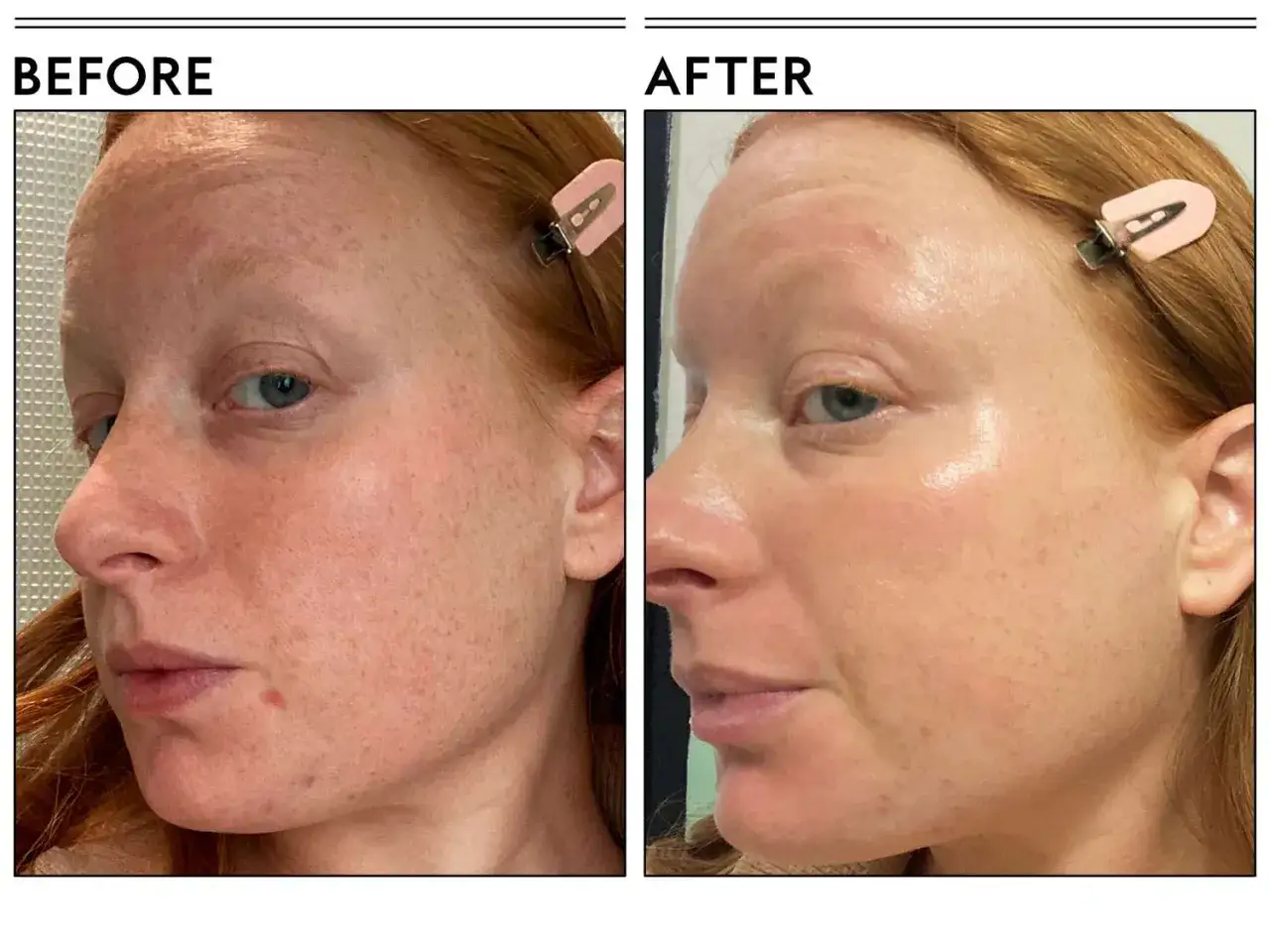 Prima e dopo: pelle arrossata e con imperfezioni, poi più luminosa e uniforme. Alcuni temono che la niacinamide faccia venire brufoli, ma qui si vede un miglioramento.