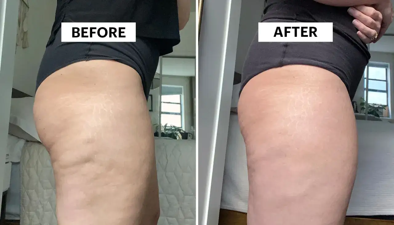 Prima e dopo: la pelle mostra un miglioramento visibile, con un effetto di rompere i noduli di cellulite e levigare le smagliature.