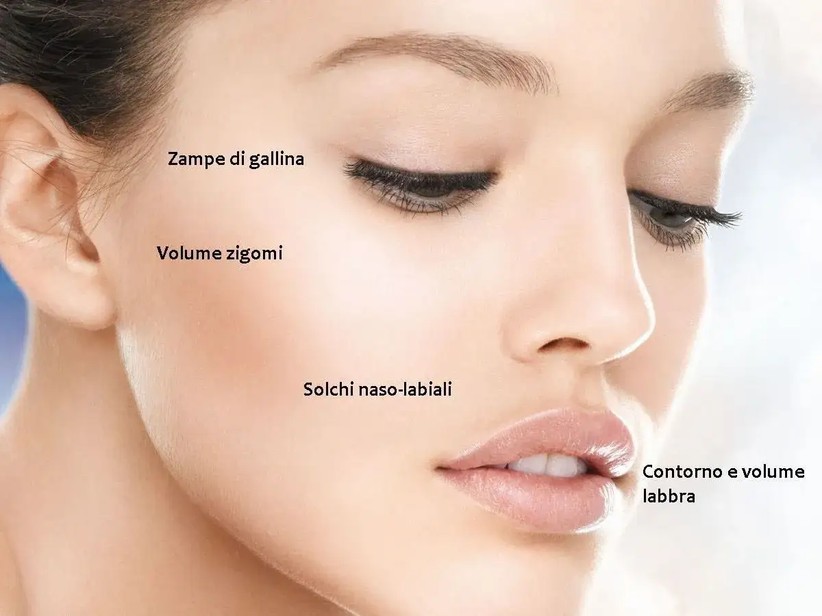 Primo piano del viso di una donna con indicazioni su come rimpolpare il viso: zigomi, labbra, zampe di gallina e solchi naso-labiali.