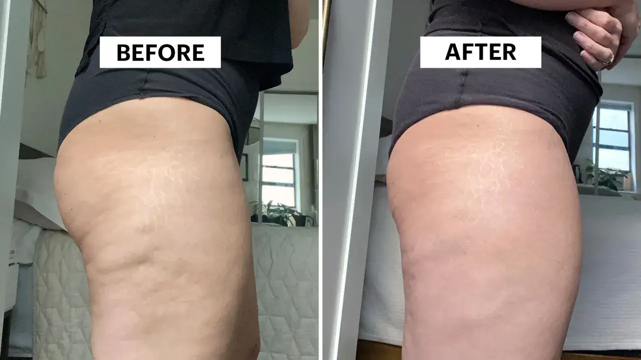 Prima e dopo: miglioramento visibile della cellulite edematosa grazie a rimedi efficaci. La pelle appare più liscia e tonica.