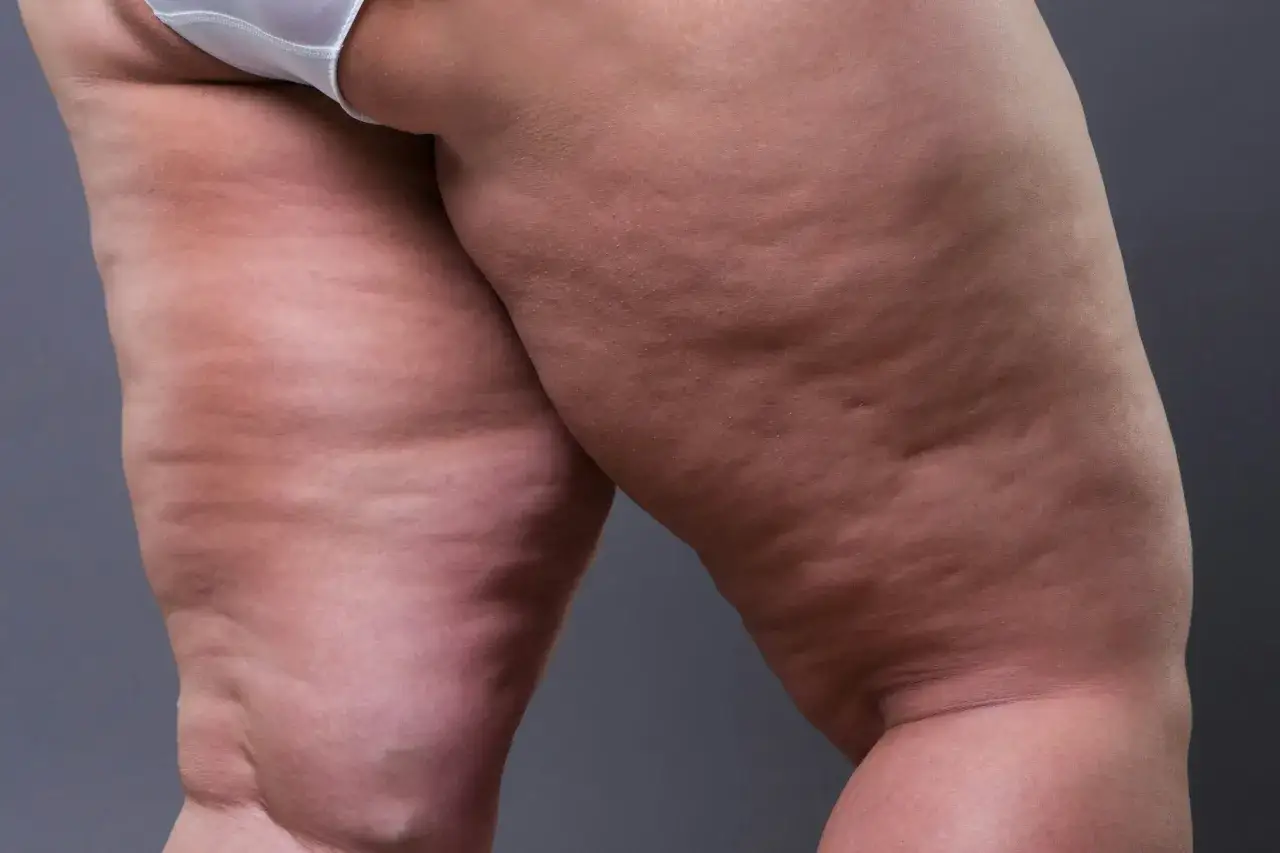 Gambe con pelle che presenta le tipiche ondulazioni della buccia d'arancia, evidenziando la texture cutanea.