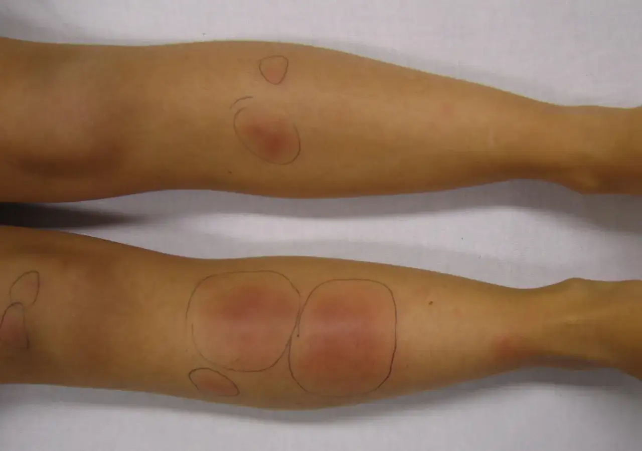 Gambe con macchie rosse e gonfie, alcune cerchiate a matita. Le lesioni sembrano reazioni cutanee.