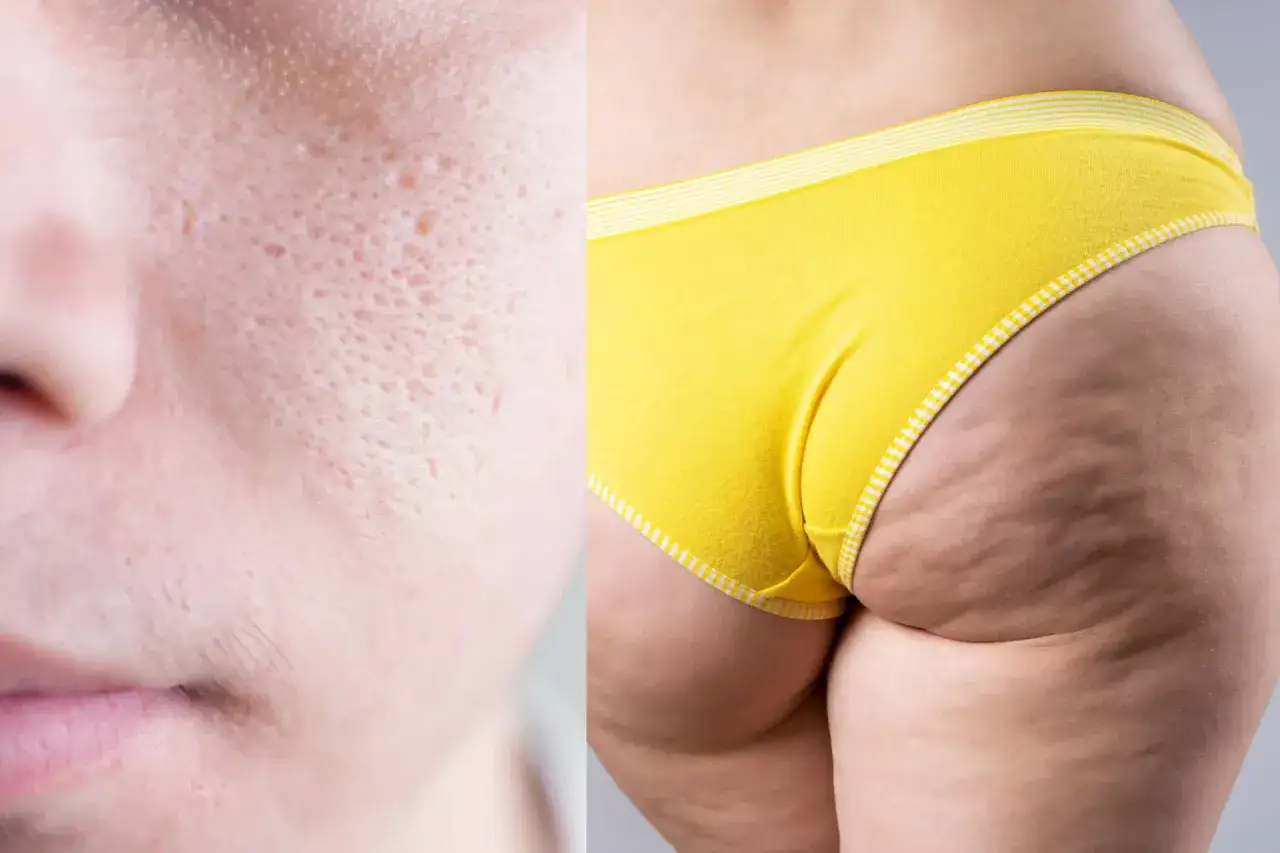 Primo piano di pelle con pori dilatati e lato B con cellulite, per mostrare come creme anticellulite funzionano.
