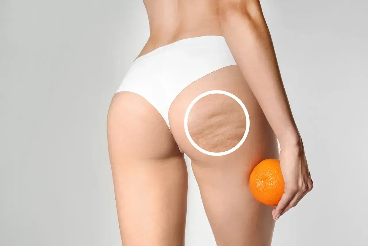 Gambe con cellulite secondo stadio, evidenziata da un cerchio. Un'arancia simboleggia la texture della pelle.