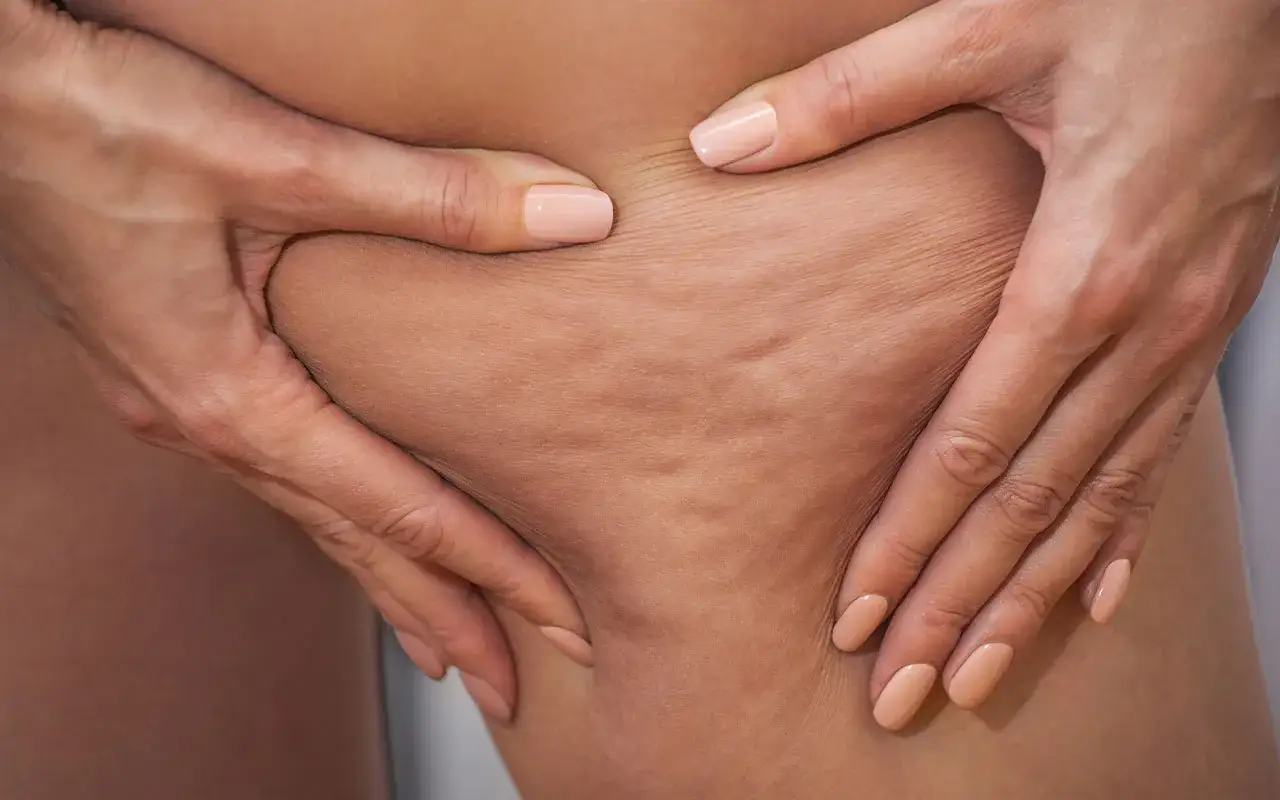 Mani che stringono la pelle mostrando le prime rugosità tipiche della cellulite primo stadio.