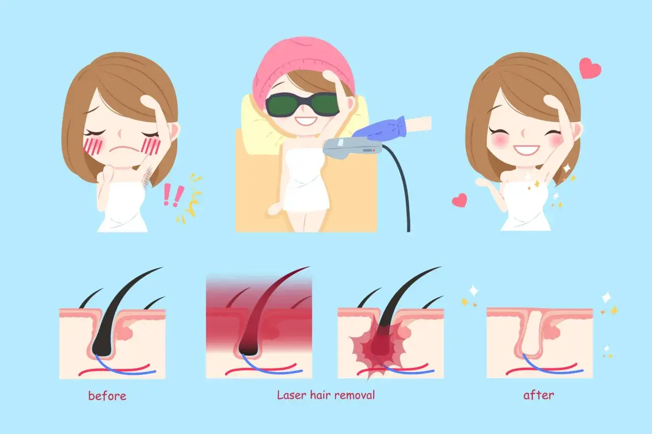 Illustrazione che mostra il prima e il dopo della depilazione femminile con laser. Una donna &egrave; felice e liscia dopo il trattamento.