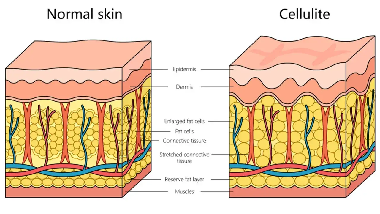Confronto tra pelle normale e cellulite: la differenza è nell'adipe e nel tessuto connettivo.