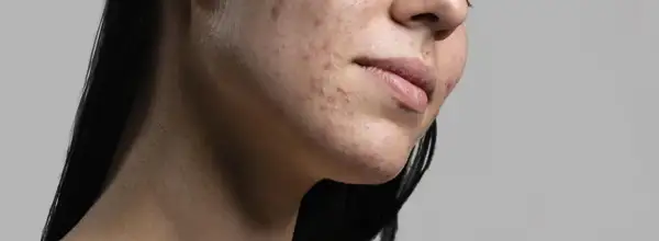 Primo piano del viso di una donna con acne. La resorcina cos'è? Un trattamento per la pelle.