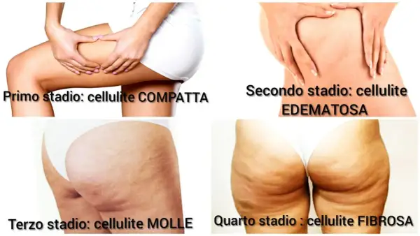 Le immagini mostrano i quattro stadi della cellulite, da compatta a edematosa, molle e fibrosa. La cellulite fa male e può peggiorare con il tempo.