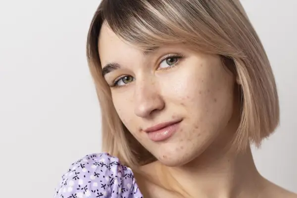 Primo piano di una giovane donna con brufoli da stress sul viso. Impara a riconoscerli e a gestirli.