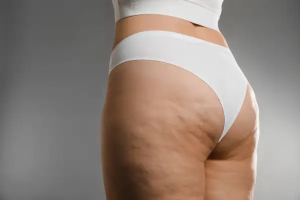 Gambe e glutei con cellulite di stadio avanzato, mostrando la texture della pelle. Ricerca di cellulite 4 stadio rimedi.