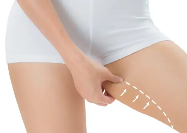 Mano che pizzica la pelle flaccida interno coscia, con frecce bianche che indicano un'area da trattare.