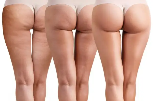 Gambe con cellulite fibrotica visibile, che mostra la progressione verso una pelle più liscia.